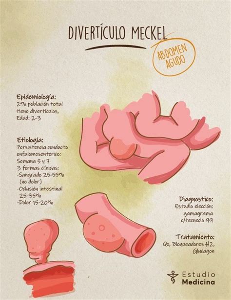 Divertículo Meckel Cosas de enfermeria Medicina Diagnosticos de