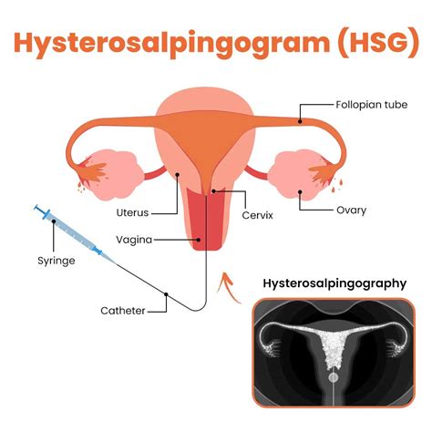 What Is Hysterosalpingography Hill Regional Hospital