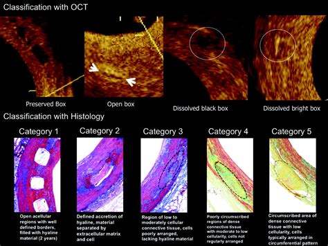 Intracoronary Optical Coherence Tomography And Histology At Month And