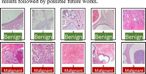 Benign Tumor Histology