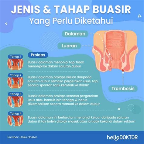 Buasir Ketika Mengandung Jejaskan Peluang Ibu Bersalin Normal