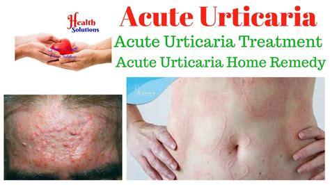 Urticaria Causes And Treatment