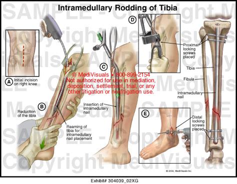 Intramedullary Rodding Of Tibia Medical Illustration Medivisuals