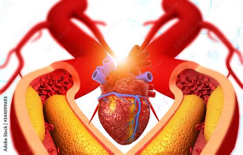 Human Heart Anatomy And Clogged Arteries 3d Illustration Stock