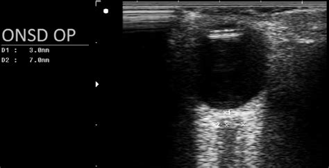 Ultrasound image of the right optic nerve with sheath and its width ...