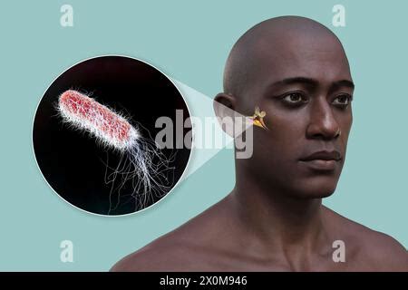 D Illustration Of A Man With A Bacterial Infection Of The Middle Ear