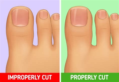 How To Prevent Ingrown Toenails 5 Minute Crafts