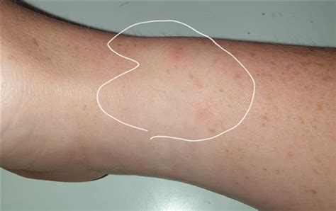 Itchy Rash On Wrists