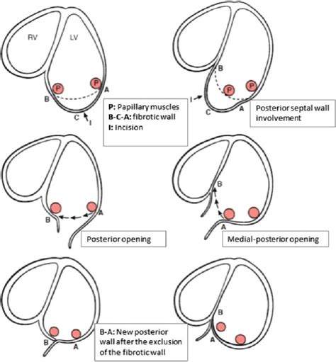 Schematic Surgical Ventricular Reconstruction Technique According To