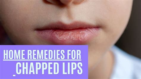 10 Natural Home Remedies For Chapped And Dehydrated Lips