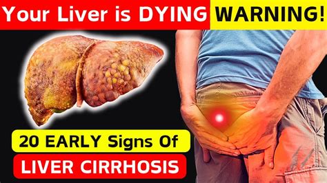 20 Early Signs Of Liver Cirrhosis Liver Is Dying Youtube