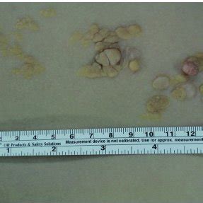 (PDF) Recurrence of Nevus Lipomatosus Cutaneous Superficialis after CO ...