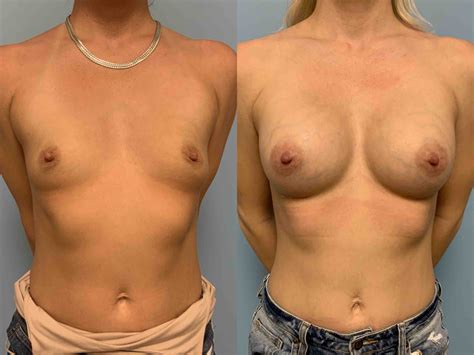 Breast Augmentation Gallery Dr Paul Vanek