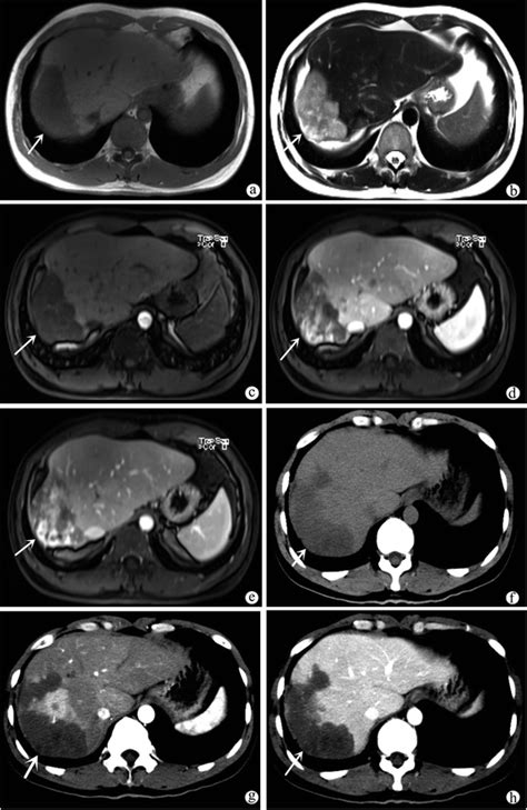 Spectrum Of Appearances On Ct And Mri Of Hepatic Epithelioid