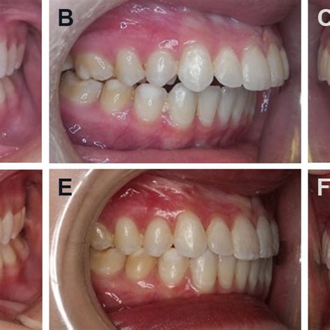 Case 2 Patient Has A Class Ii Malocclusion With An Anterior Open Bite Download Scientific