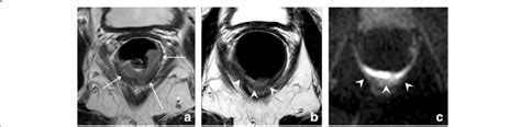 Susceptibility Artifacts On Dwi Pre Treatment T2 Weighted Mri A