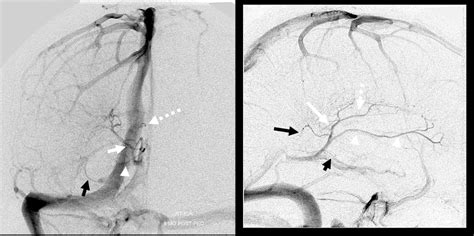 Internal Cerebral Vein | neuroangio.org