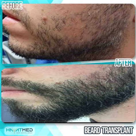 Beard Transplant In Turkey Best Scarless Results And 2024 Price