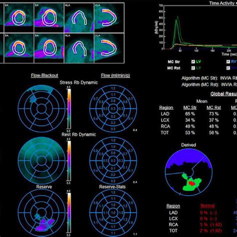 Pet Myocardial Perfusion Imaging A Mpi Shows Large Myocardial