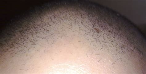 Scalp peeling with 20% glycolic acid: GREAT RESULTS... - Page 3