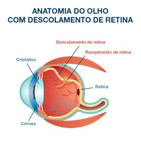 Tratamento Da Retina Instituto De Mol Stias Oculares