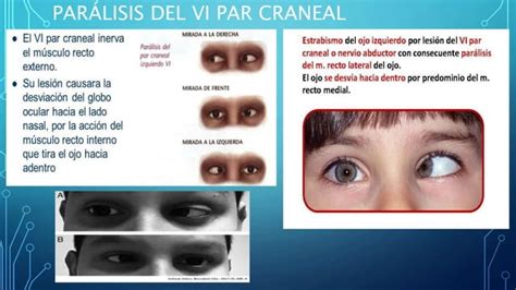 EVALUACIÓN DEL IV Y VI PAR CRANEAL pptx