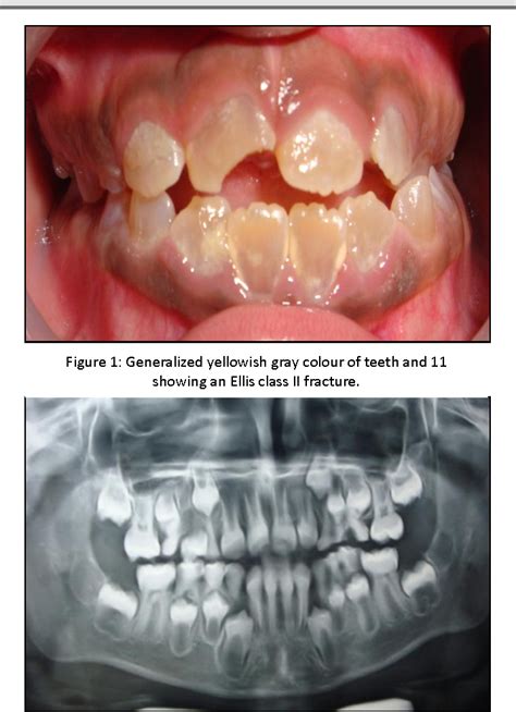 DENTINOGENESIS IMPERFECTA REVIEW PDF