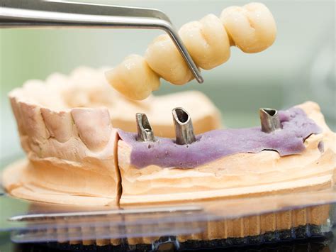 Dental Implant Bridges | Implant-Supported Bridges