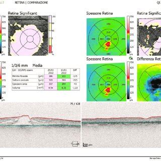 Macular hole closure: Preoperative optical coherence tomography (OCT ...