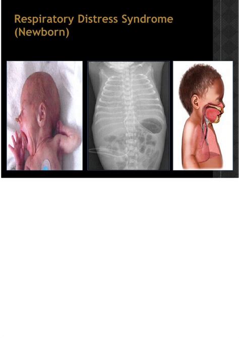 (PDF) Respiratory Distress Syndrome (Newborn) - DOKUMEN.TIPS