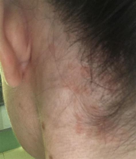 Rash On Neck At Hairline