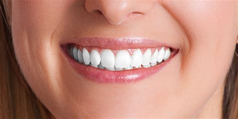 Teeth Whitening: Two Side Effects of Whitening Your Teeth | Oral Answers