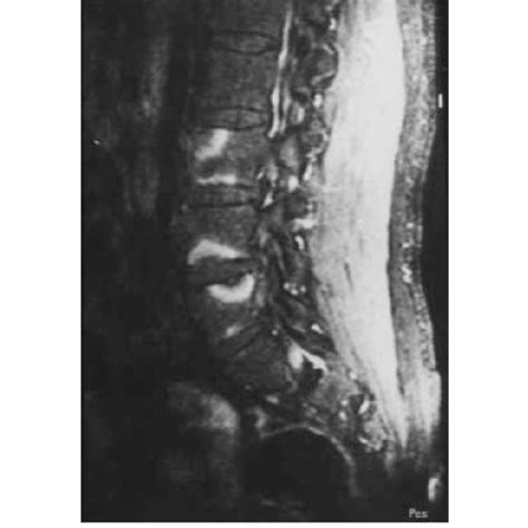 Pdf Brucellar Spondylitis Mri Findings