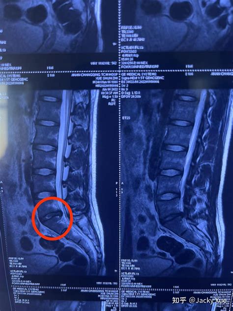 23岁l5s1腰椎间盘突出（脱出）引起脚麻的4个月记录 知乎