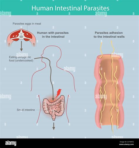 Parásitos intestinales humanos Ilustración Explique los parásitos en