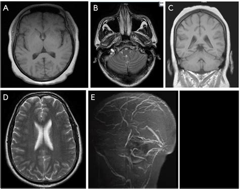 A E Magnetic Resonance Imaging Mri And Magnetic Resonance Venography