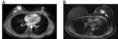 Benign And Malignant Breast Masses On Mri A Benign Looking Breast