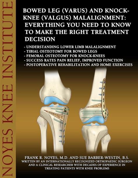 Bowed Leg Varus And Knock Knee Valgus Malalignment Everything You Need To Know To Bol