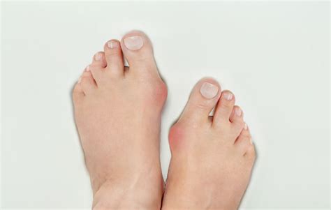 Bunion Surgery On Both Feet