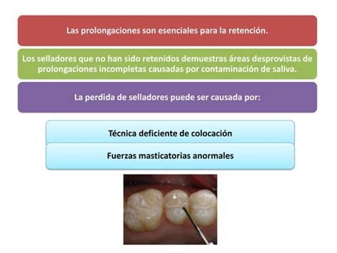 Selladores De Fosas Y Fisuras Ppt