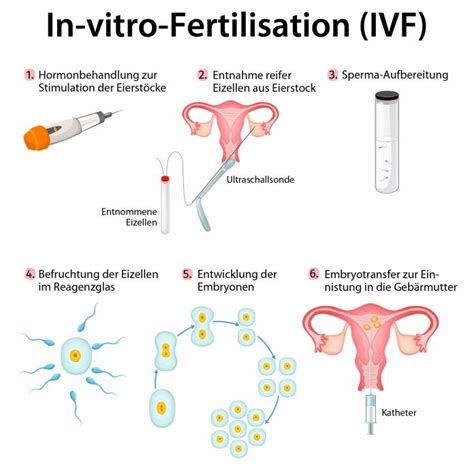 K Nstliche Befruchtung M Glichkeiten Methoden Risiken