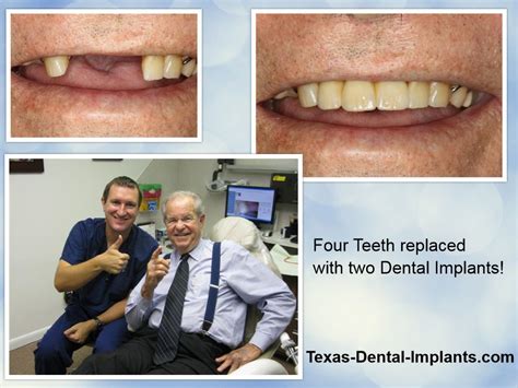 Deer Park La Porte Dental Implant Dentist Texas Implants