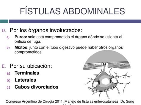 Abdominal Fistula Surgery