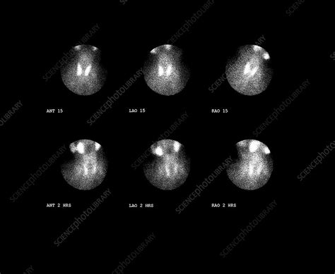 Nuclear Medicine Scan Of Thyroid Gland Stock Image P7500152