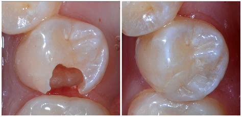 Direct Restorations: Dentsply SDR - Smart Dentin Replacement. Proximal ...