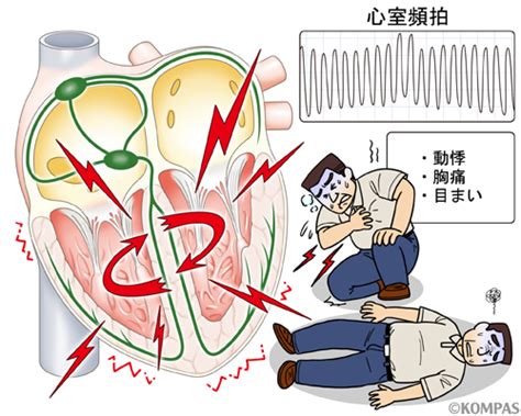 発作性上室性頻拍・心室頻拍｜慶應義塾大学病院 Kompas