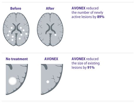 How does Avonex Work? - Pharma-Drug Project