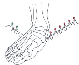 Tarsal Tunnel Syndrome Posterior Tibial Neuralgia Ankle Foot And