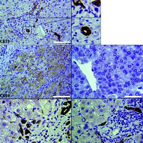 Ihc Staining For Ck19 In Tumor And Peritumoral Areas A A A A A