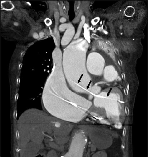 Figure From Iatrogenic Perforation Of The Left Ventricle During